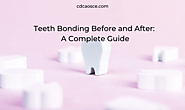 Teeth Bonding Before and After: A Complete Guide - 2025