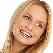 Fixed braces are available in different colours