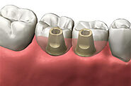 Eat & Smile With Confidence | Get Dental Implants In Ipswich