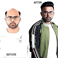 Best Hair Patches for Men – Natural Look & Comfortable Fit