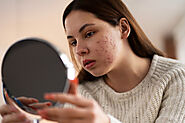 Best Treatments for Acne Scars in 2025