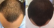 Best Hair Transplant & Cosmetic Surgery in Udaipur