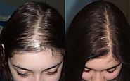 How to cure hair fall problem in udaipur