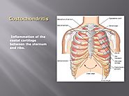 Costochondritis Symptoms, Treatment – Natural Herbal Product | Herbal Care Products