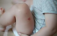 5 Ways to Prevent Diaper Rashes in Summer