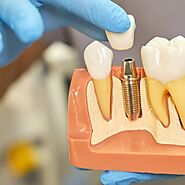 Dental Implants in Kochi | Expert Treatment at Dr. Bobby's Dental Clinic