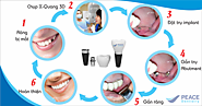Các vấn đề xoay quanh việc trồn răng implant