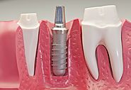 Thăc mắc về yếu tố ảnh hưởng giá trồng răng implant