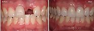 Biện pháp làm răng implant có áp dụng cho trồng răng implant