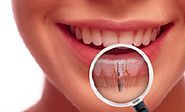 Thông tin Về việc làm cho răng implant bạn nên biết