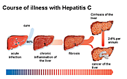 Know Different Stages of Hepatitis C...