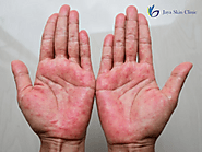 From Itch to Ease: Transform Your Skin with Eczema Care