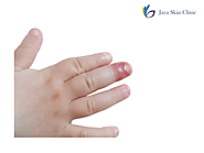 Top Treatments for Nail Infections at Our Kamla Nagar Clinic