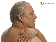 Advanced Care for White Patches by the Best Dermatologist in South Delhi