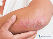 Soothe Scaly Skin with Expert Psoriasis Care in North Delhi
