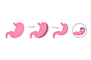 Gastric Plication Surgery in Hyderabad | Weight Loss Clinic