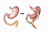 Roux-en-Y Gastric Bypass Surgery in Hyderabad | Weight Loss Clinic
