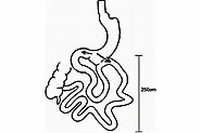Sleeve Gastrectomy With Loop Surgery | Weight Loss Clinic