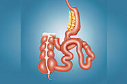 SADI-S Bypass Surgery | Best Weight Loss Clinic in Hyderabad