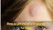 How To Get Rid Of A Bruise Fast With Naturally - Home Remedies Living