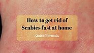 How To Get Rid Of Scabies Fast At Home? - Home Remedies Living