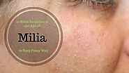 How To Get Rid Of Milia? - Milia Removal - Home Remedies Living