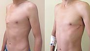 Obtain the Best Pectus Carinatum Treatments Both Surgical and Non-surgical