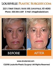 Louisville Plastic Surgeon