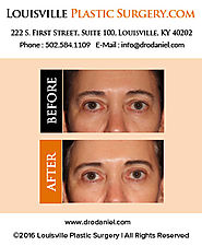 Louisville Plastic Surgeon