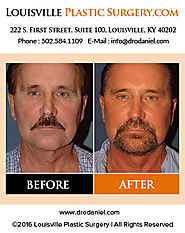 Louisville Plastic Surgeon