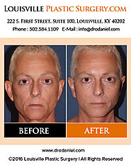 Louisville Plastic Surgeon