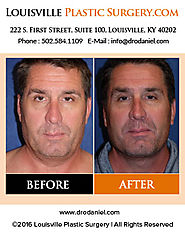 Louisville Plastic Surgeon