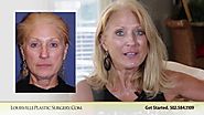 Face and neck lift Carla Age 63 Choosing Dr O'Daniel