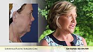 Facelift necklift tummy tuck denise choosing Dr O'daniel