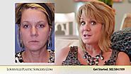 injectables liquid facelift lisa about my procedure