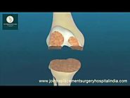 Total Knee Replacement Surgery in India - Low Cost