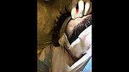 Hair Transplant Part 3 - Extracting Grafts