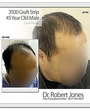 Dr. Robert Jones Hair Transplant Center Toronto
