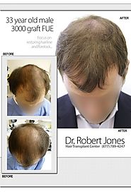 Dr. Robert Jones Hair Transplant Center Toronto