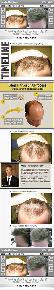 Hair Restoration Surgery Case Study – Ben