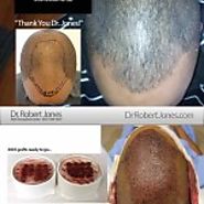 3003 Graft FUE Hair Transplants - Curly African-American Hair
