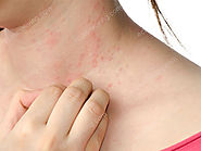 Eczema skin infection