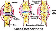 Affordable Knee Replacement Surgery for Osteoarthritis in India