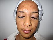 Chemical Peel Treatment In Kolkata: Cost, Results & Procedure