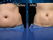 Freezing fat cells: Coolsculpting claims to remove fat without surgery