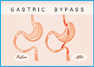 Consult Dr. Ravi Rao for Gastric Bypass Surgery in Australia