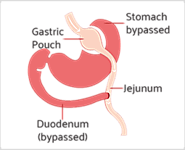 Contact Dr. Ravi Rao for Gastric Bypass Surgery in Perth, AU