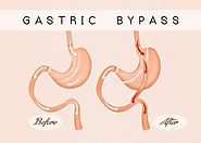 Answering 5 Frequently Asked Questions about Gastric Bypass Surgery