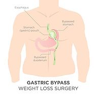 Answering 5 FAQs about Roux-en-Y Gastric Bypass