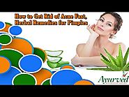 How to Get Rid of Acne Fast, Herbal Remedies for Pimples